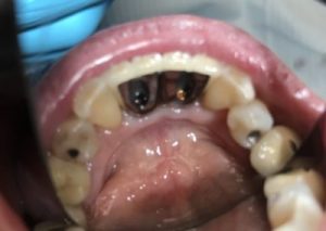 cavities in teeth
