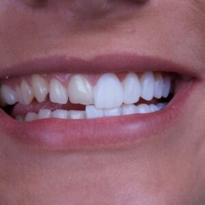 Uneven teeth